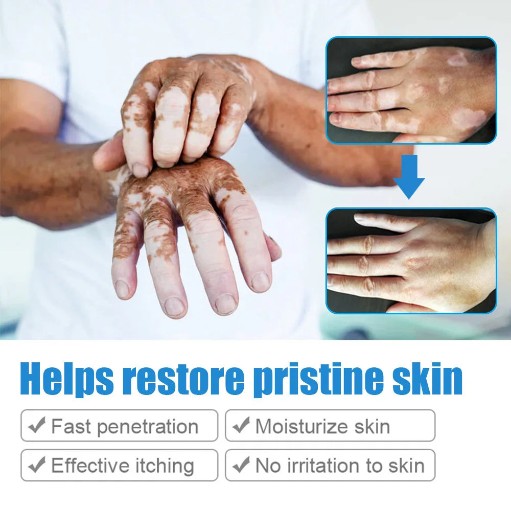 SELUMB Vitiligo & Pityriasis Alba Treatment Cleansing Soft Cream 20g for Body All Skin Types External Use