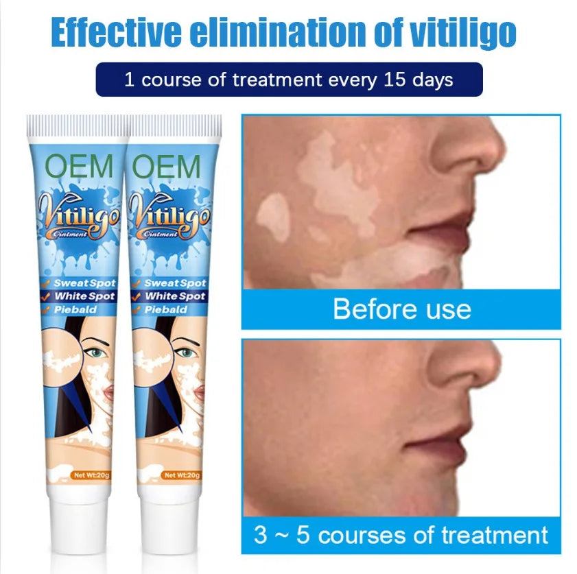 SELUMB Vitiligo & Pityriasis Alba Treatment Cleansing Soft Cream 20g for Body All Skin Types External Use